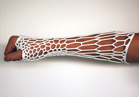 custom-3d-printed-cast